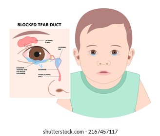 Blocked tear duct eye sinus toddler red dry swollen nasal nose pain eyelid Gland medial system drain sac birth baby child obstruct tumor polyps pink Mucus Eyedrop glaucoma Dacryolith disease