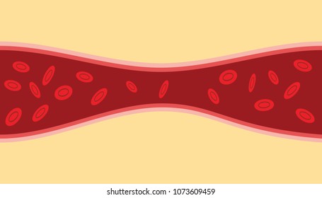 A Blocked Vessels With Narrow Stream Blood Cells