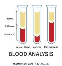 Blood Analysis Infografics. Glassware Tubes Filled Blood In Layers. Plasma And Hematocrit, Buffy Coat. Deviation Of Blood - Anemia And Polycythemia. Vector Illustration