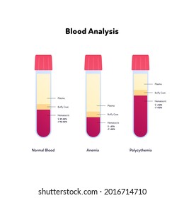 Blood Analysis Infographic. Vector Flat Healthcare Illustration. Blood Sample Of Normal, Anemia And Polycythemia. Design For Pharmacy, Health Care.