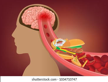 Blood Can't Flow Into Human Brain Becaue Fast Food Made Clogged Arteries. Illustration About Stoke Disease And Medical Concept.