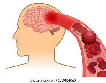 Blood Cell Can't Flow Into Human Brain Because Clogged Arteries By Blood Clot. Illustration About Stroke And Medical Concept.