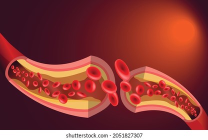 Blood cells in an artery. Normal blood flow. The accumulation of cholesterol in the blood vessels. Atherosclerotic plaque. Medical poster.