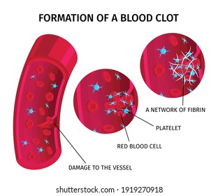 Blood Cells Thrombus Coagulation Educative Infographic Colorful Chart Depicting Clot Formation Process Vector Illustration 