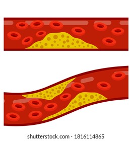 118 Healthy and blocked arteries with red erythrocytes Images, Stock ...