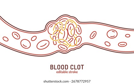 Blutgerinnselhintergrund. Bearbeitbare Vektorgrafik von Gefäßverstopfung mit Blutplättchen. Verwendet in der Gesundheitsversorgung, Schlaganfallprävention, Thrombosebewusstsein und Kreislaufsystemerziehung.
