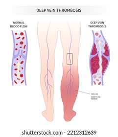 Blood Clot Disease Chronic Leg Pain Varicose Veins Swelling Obesity Ankle Foot Diabetes Syndrome