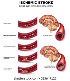 Blood Clot Formation Cerebral Artery Blocked Stock Vector (Royalty Free ...