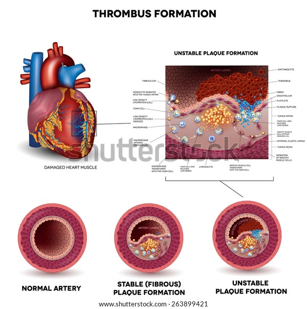 Blood clot formation.\
Coronary artery disease. Anatomy of Healthy artery, unhealthy\
arteries, human heart muscle damage and detailed illustration of\
plaque formation.