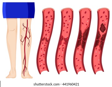 Blood Clot In Human Legs Illustration (deep Vein Thrombosis)