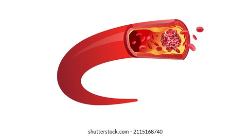 Blood Clot Made From Red Blood Cells Linked By Fibrin Filaments. Vector Illustration On White Background.