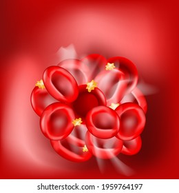 Blood Clot On Red Background. Thrombus That Has Blocked A Blood Vessel. Blood Coagulation. Hemostasis. Vector Illustration