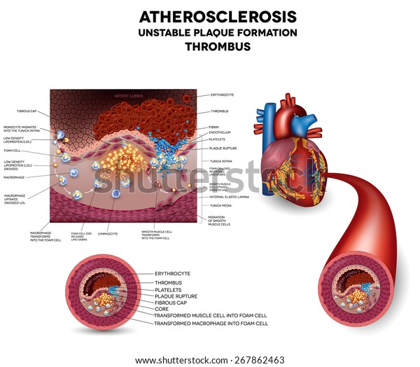 Blood Clot Plaque Rupture Blood Clot Stock Vector (Royalty Free ...