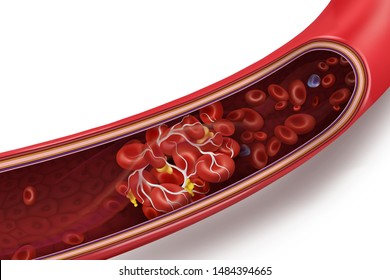 Blood clot (thrombus) in vein. Vector 3d illustration isolated on white transparent background.