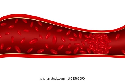 Blood Clot In Vein. Thrombosis Concept In White Isolated Background. Vector 3D Illustration.