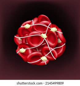 Blood clots block the flow of blood. Red blood cells, platelets and fibrin.