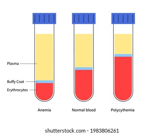 Blood Composition In Proportions, Plasma, Buffy Coat And Erythrocytes. Specimens With Anemia, Normal Blood And Tube With Polycythemia. Microbiology Test In Laboratory Vector Illustration For Clinic