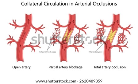 blood flow changes in artery from open flow to partial blockage and total occlusion, highlighting collateral circulation diagram hand drawn schematic vector illustration. Medical science educational