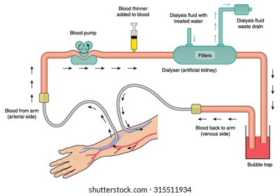 Blood flow through kidney dialysis machine, from arterial blood, through the pump, filter, bubble trap and return flow to the venous circulation.