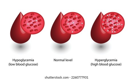 Niveles de glucosa en sangre. Nivel normal, hipoglucemia (bajo nivel de azúcar en sangre), hiperglucemia (alto nivel de azúcar en sangre), análisis de azúcar. diagrama de vector