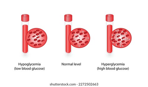Blood Glucose Levels. Normal level, hypoglycemia (low blood sugar), hyperglycemia (high blood sugar), sugar test. vector diagram