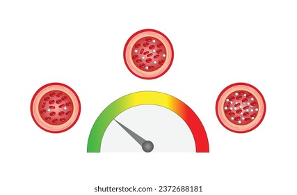 Niveles de glucosa en sangre. Nivel normal, hipoglucemia (bajo nivel de azúcar en sangre), hiperglucemia (alto nivel de azúcar en sangre), análisis de azúcar. diagrama de vector