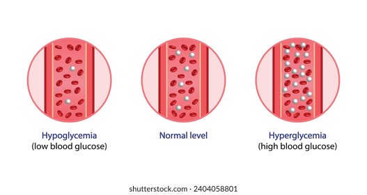 Niveles de glucosa en sangre. Nivel normal, hipoglucemia (bajo nivel de azúcar en sangre), hiperglucemia (alto nivel de azúcar en sangre), análisis de azúcar. diagrama de vector