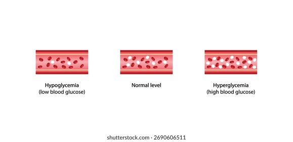 Níveis De Glicose No Sangue. nível normal, hipoglicemia (nível baixo de açúcar no sangue), hiperglicemia (nível elevado de açúcar no sangue), teste de açúcar. Ilustração de vetor.