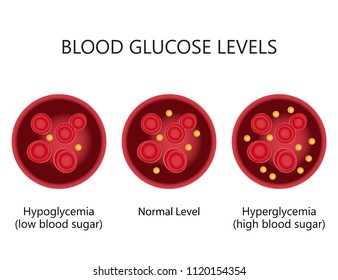 Blood Glucose (Sugar) Levels. High level is referred to as hyperglycemia. Low levels are referred to as hypoglycemia. Vector illustration 