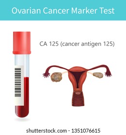 Blood Ovarian Cancer Marker Test. CA 125. Uterus, Ovary With A Tumor. Vector Medical Illustration. White Background.