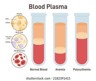 Blood Plasma. Structure Of Normal Blood, Blood With Anemia And Polycythemia. Test Tube With Red And White Blood Cells And Plasma. Flat Vector Illustration