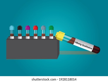 Muestra de sangre para la prueba de HBeAg (antígeno e del virus de la hepatitis B). Un concepto de prueba médica con vector de tubo en el fondo del laboratorio.