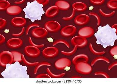 Blood Of Sickle Cell Disease. Sickled Red Blood Cells.