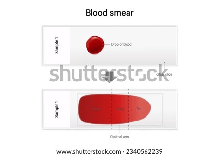 Blood smear for hematology microscopic. Method of placing drop of blood sample onto glass slide.