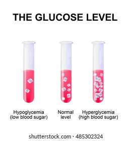 blood sugar level or glucose level. Normal level, Hyperglycemia and Hypoglycemia. test-tube with blood