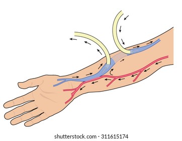 Arteriovenous Fistula High Res Stock Images Shutterstock