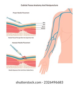 Técnica de análisis de sangre. Flebotomía, venopunción y recolección de sangre de la técnica venosa. Colocación adecuada de la jeringa. Colocación de la vena del brazo. Ilustración vectorial plana