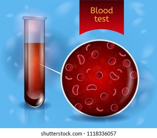 Blood Test Vector Concept or Poster with Extracted Arterial or Venous Blood in Lab Tube and Magnified Microscopic Blood Red Cells Realistic Illustrations. Hematological Laboratory Diagnostic Research