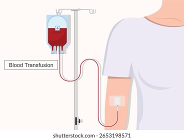 La transfusión de sangre es un procedimiento común en el que se administra sangre donada o componentes sanguíneos a través de una vía intravenosa (IV). Atención médica, Ilustración vectorial.