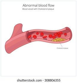 Blood vessel and cholesterol plaque vector illustration