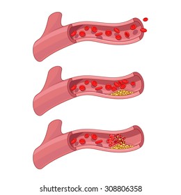 Blood Vessel And Clot Thrombus Vector Illustration