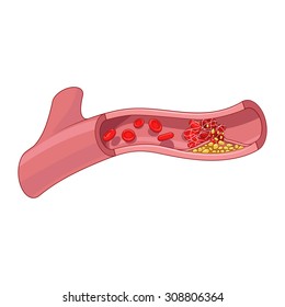 Blood vessel and clot thrombus vector illustration