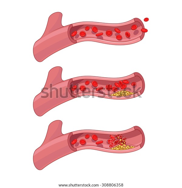 血管と血餅の血栓のベクター画像イラスト のベクター画像素材 ロイヤリティフリー