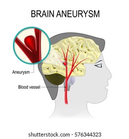 1,744 Brain aneurysm Images, Stock Photos & Vectors | Shutterstock