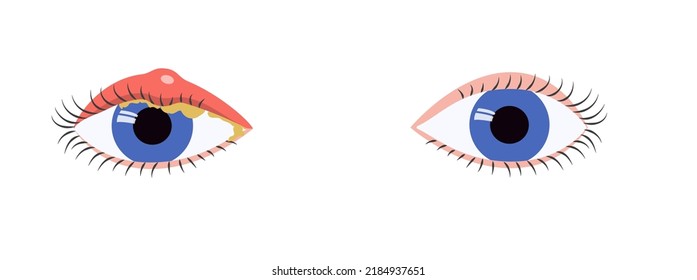 Blue eyes comparison of healthy state and blepharitis symptoms, swelling, mucus. Eye disease medical illustration.