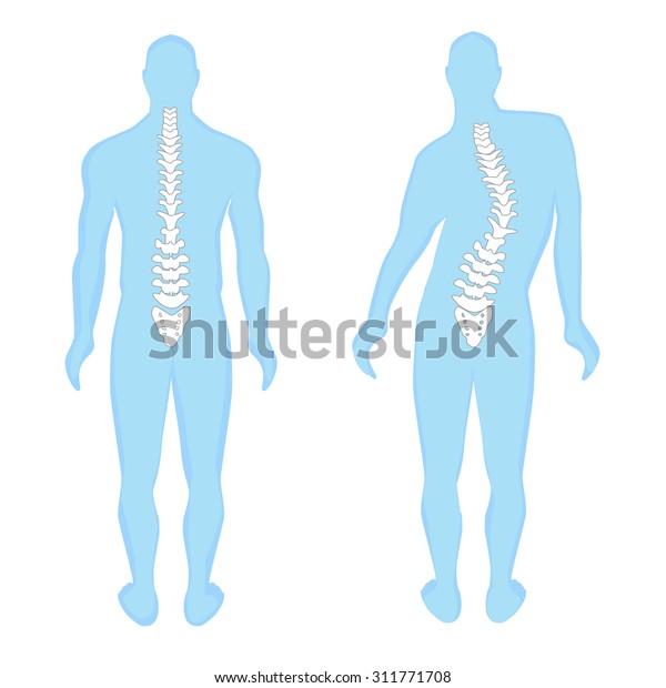 背骨を持つ青い人間の解剖学的シルエット 脊柱側弯症の健康な脊椎イラストと脊椎 現代医学のベクター画像インフォグラフィック 中間解剖学 のベクター画像素材 ロイヤリティフリー