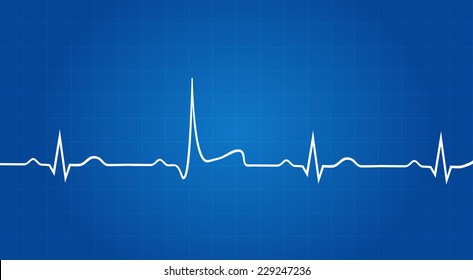 Blueprint Of Heart Attack On Electrocardiogram