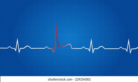 Blueprint Of Heart Attack On Electrocardiogram