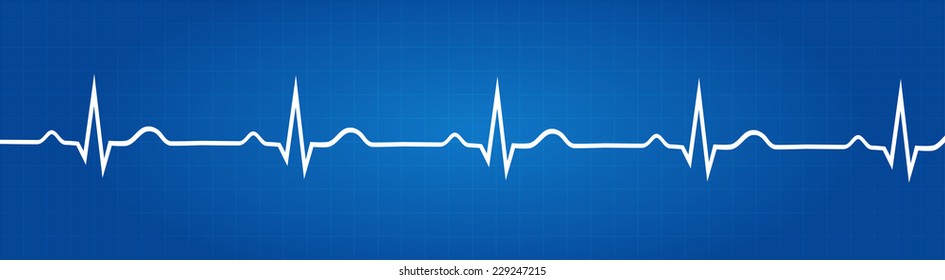 Blueprint Of Normal Electrocardiogram Graphic