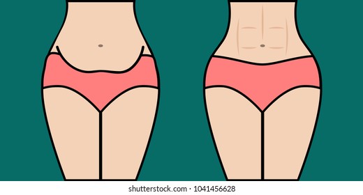 Body before and after weight loss. Woman with fat belly and girl with amazing abs, toned abdominal muscles. Vector illustration